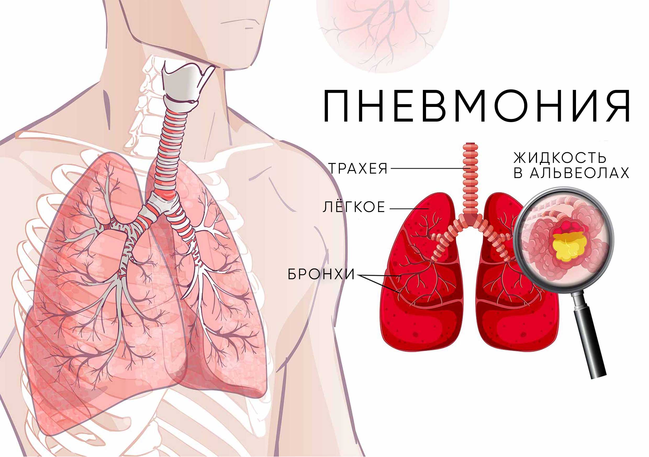 Воспаление легких и пневмония — в чем разница
