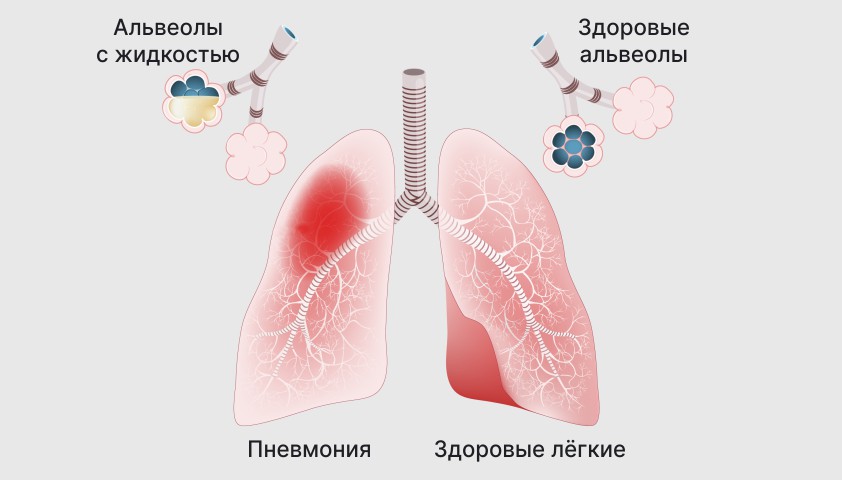 Как отличить вирусную пневмонию от бактериальной